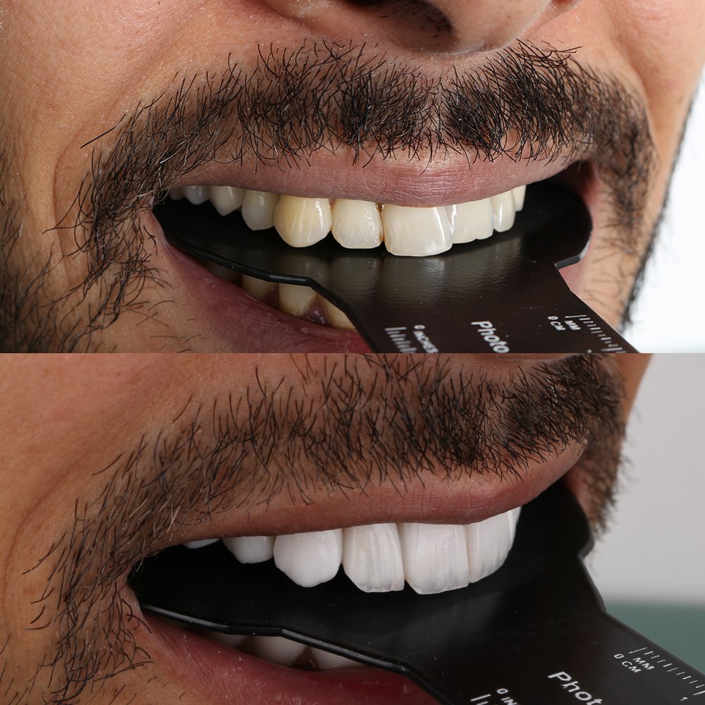 Cosmetic Veneers