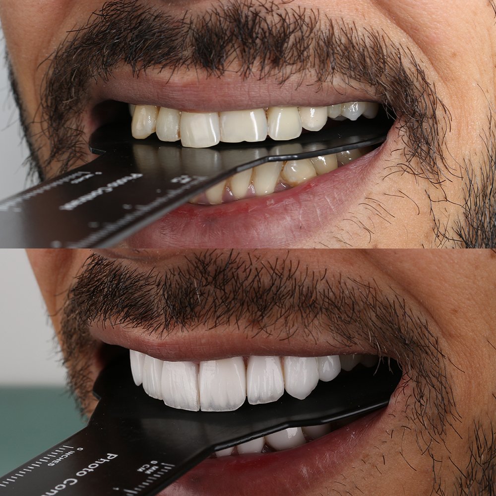 Cosmetic Veneers