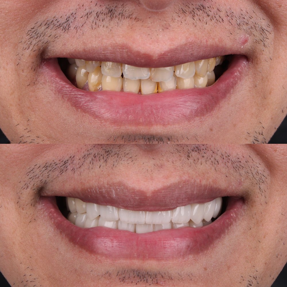 Cosmetic Veneers