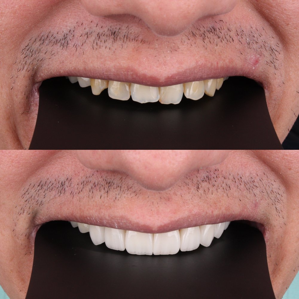 Cosmetic Veneers