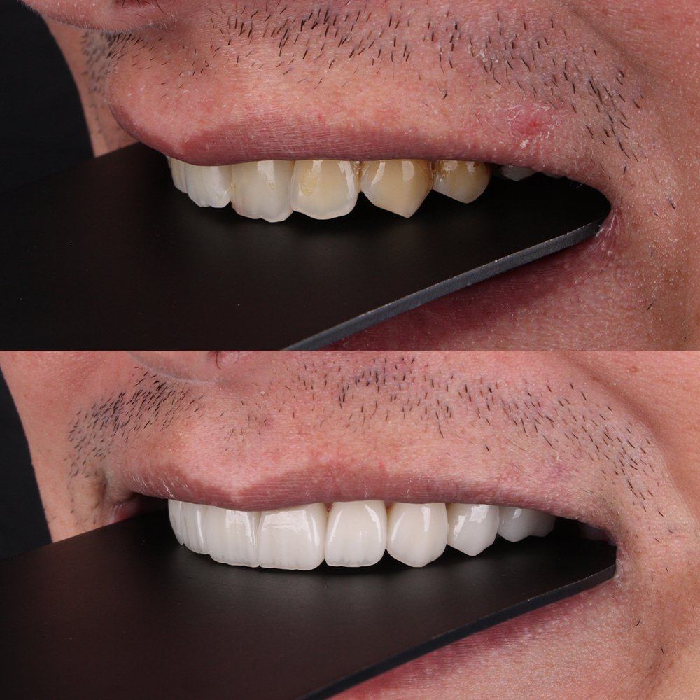 Cosmetic Veneers