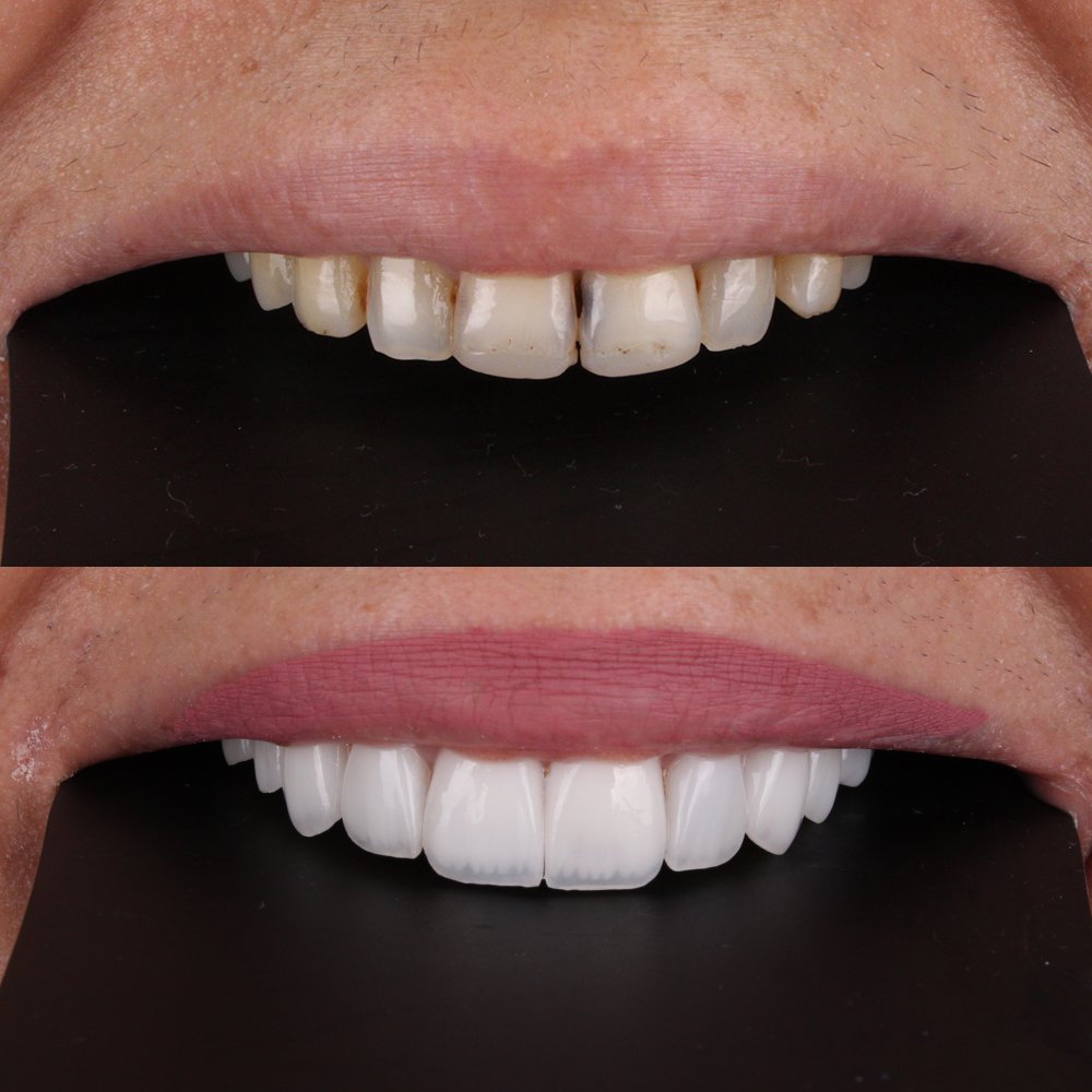 Cosmetic Veneers