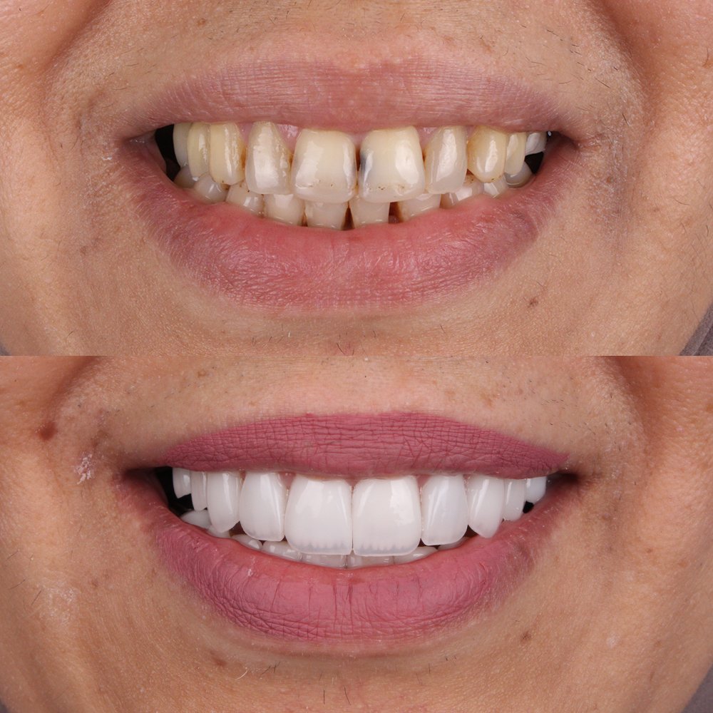Cosmetic Veneers