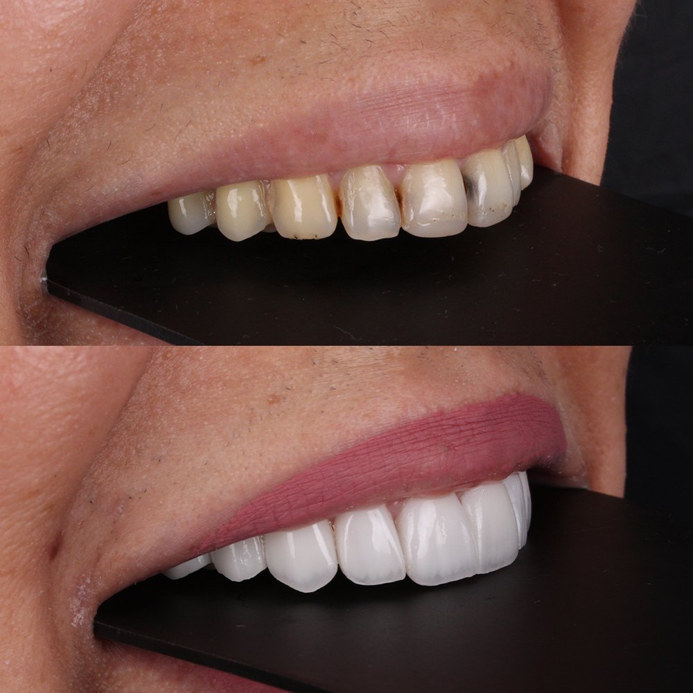 Cosmetic Veneers
