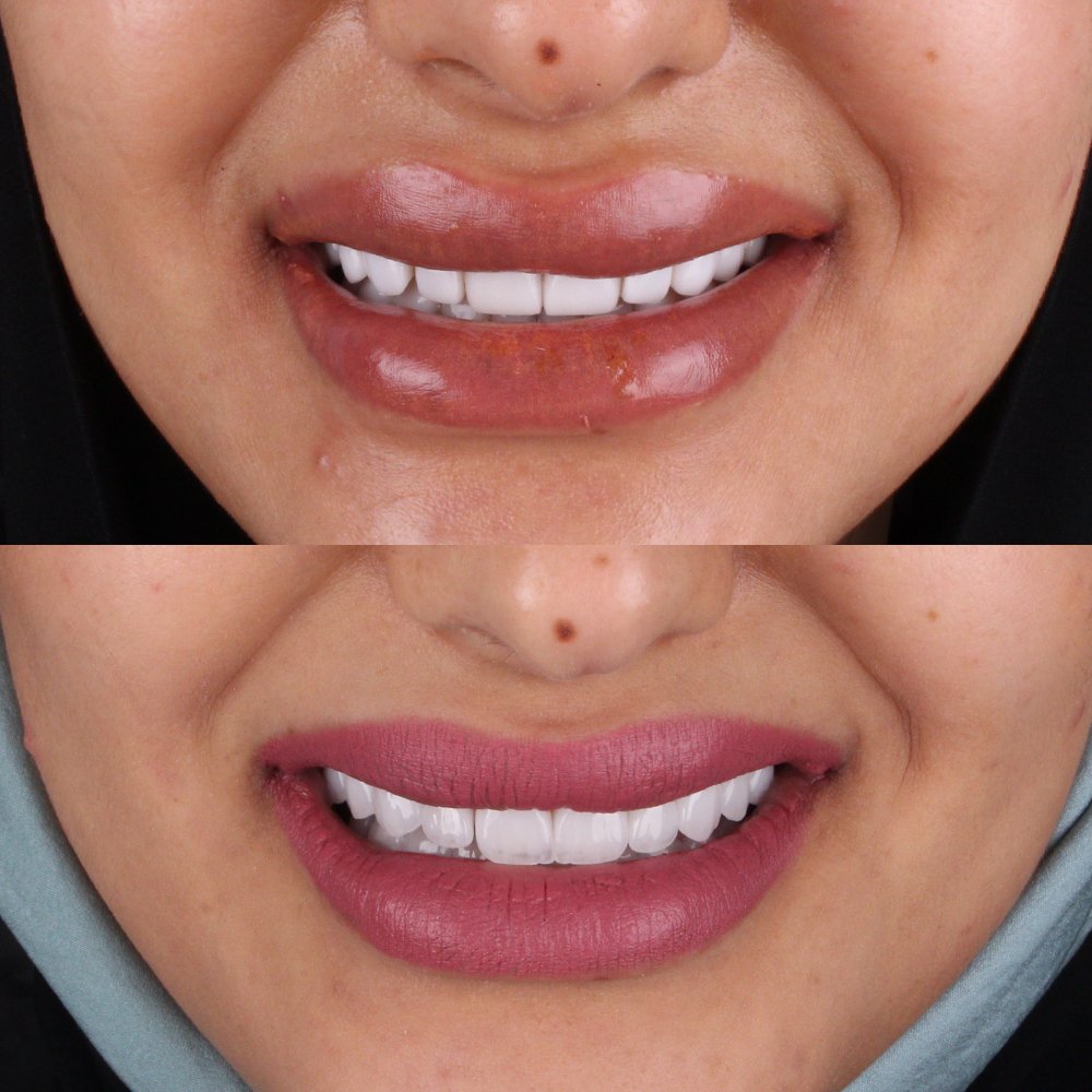 Cosmetic Veneers