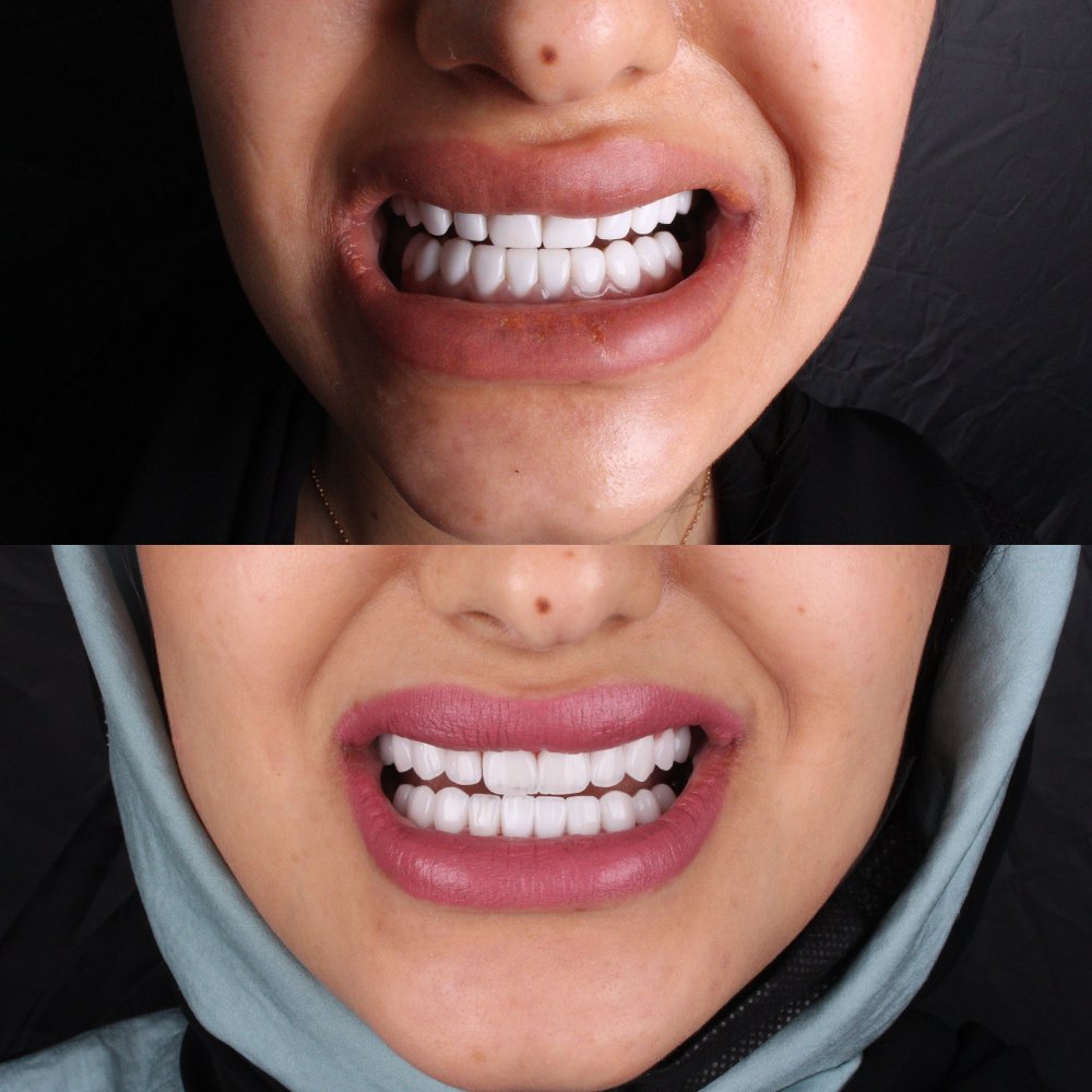 Cosmetic Veneers