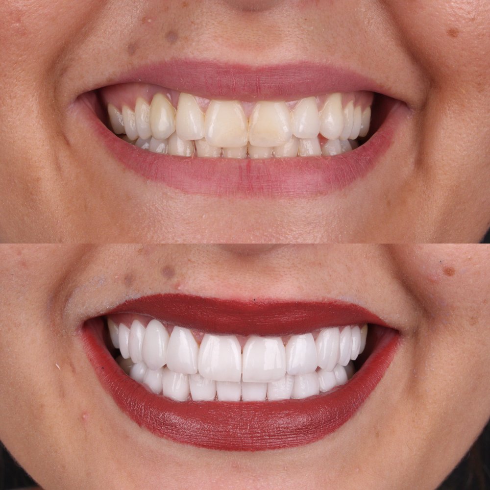 Cosmetic Veneers