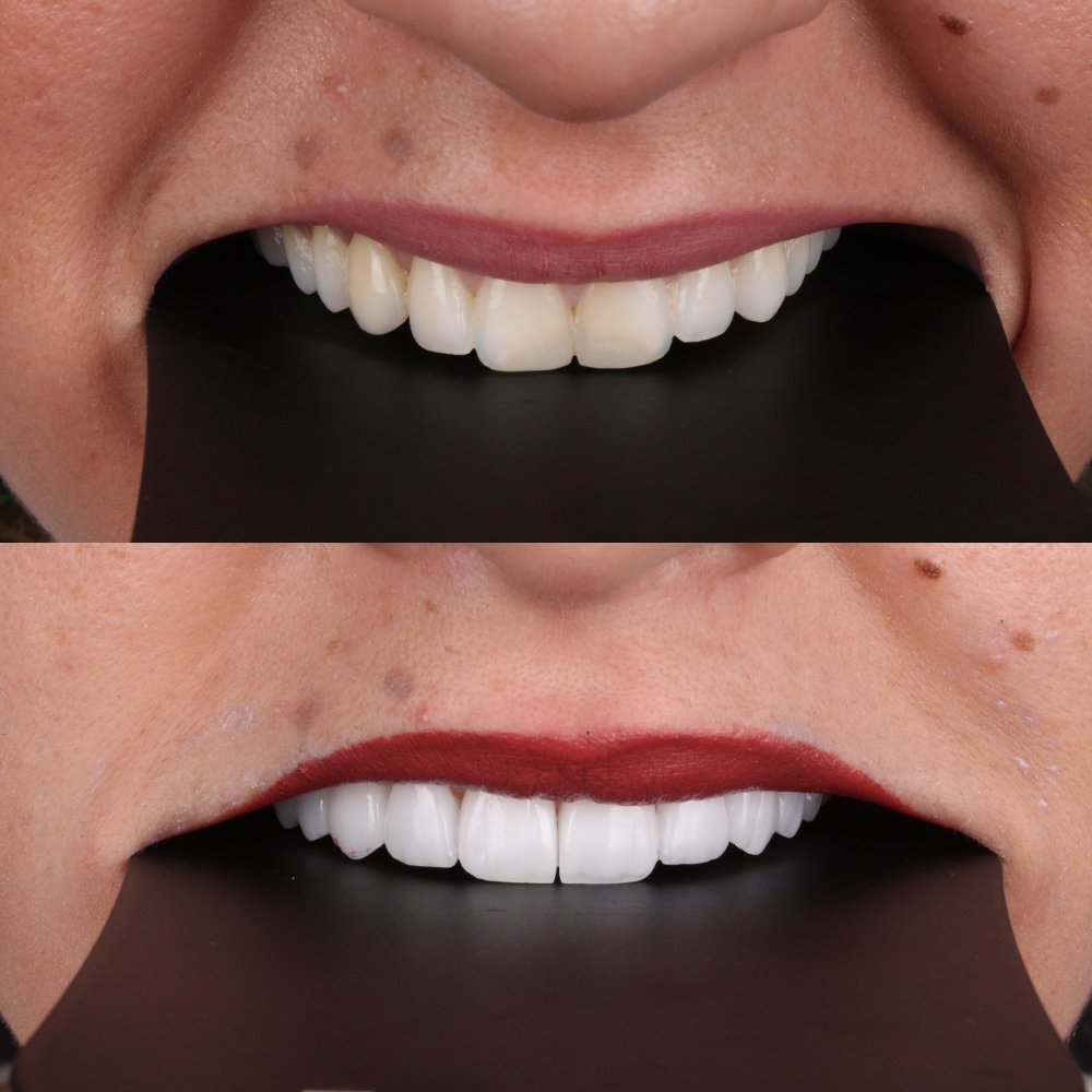 Cosmetic Veneers