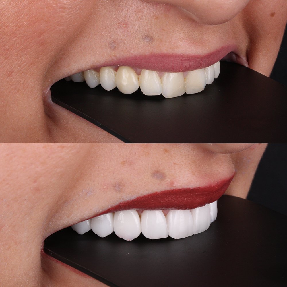 Cosmetic Veneers