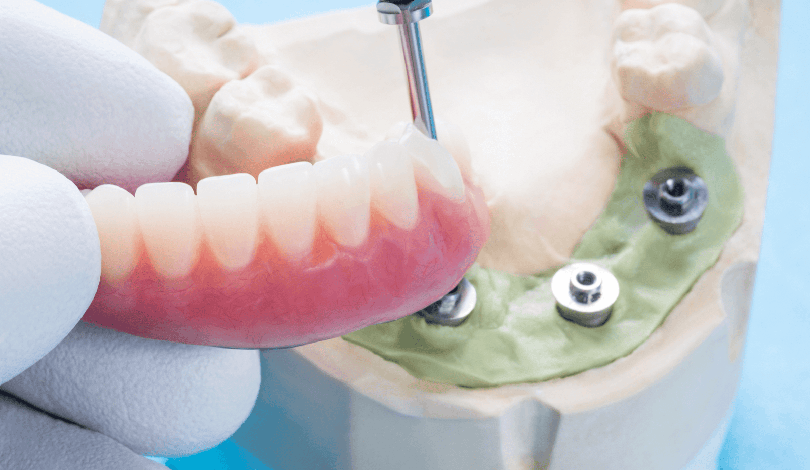 Conventional Full Arch