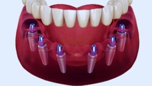 Mini dental implants UAE: Your Guide to Affordable, Efficient