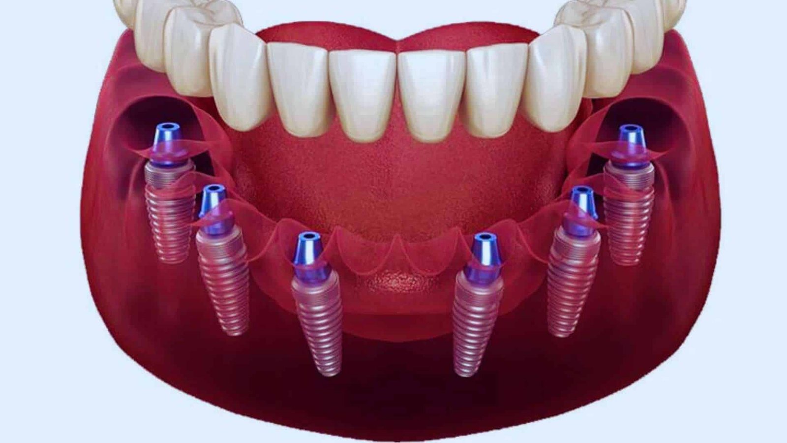 mini dental implants UAE