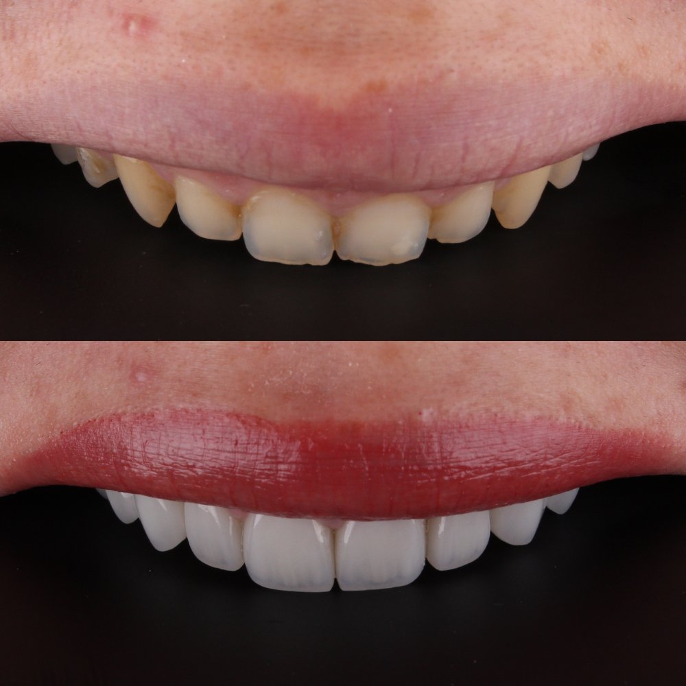 Cosmetic Veneers