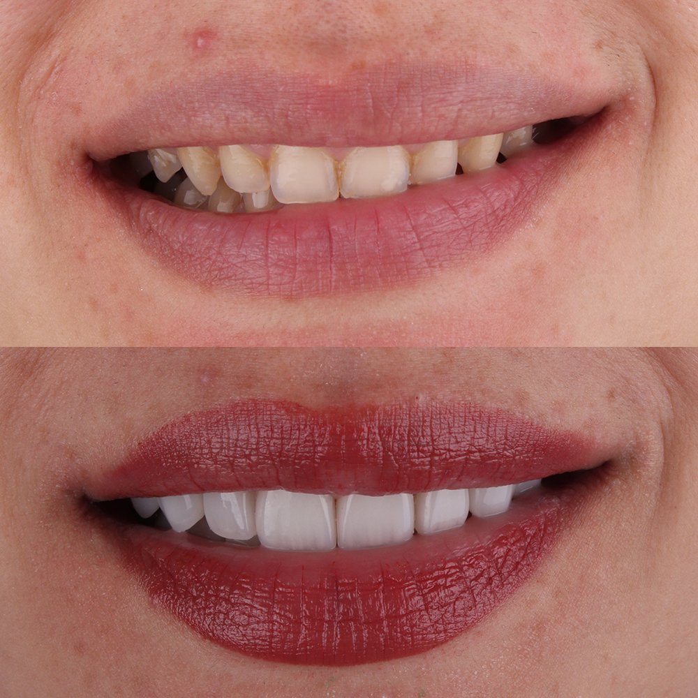 Cosmetic Veneers