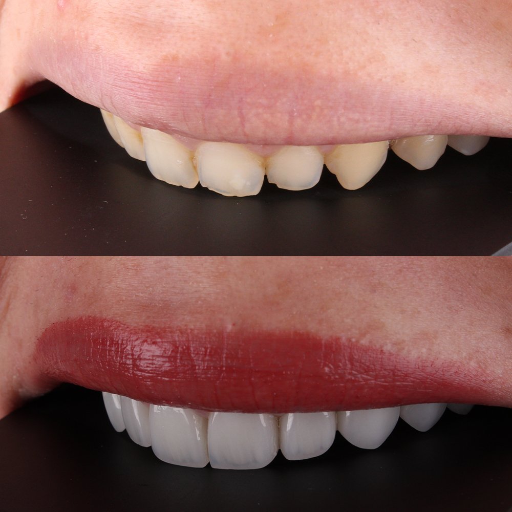 Cosmetic Veneers