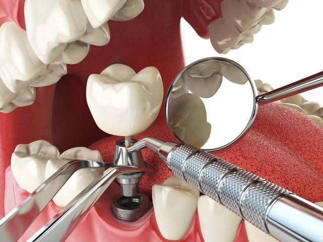 Post-operative monitoring following implant surgery