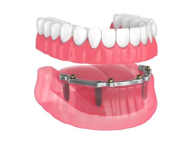 Implant-Supported Dentures