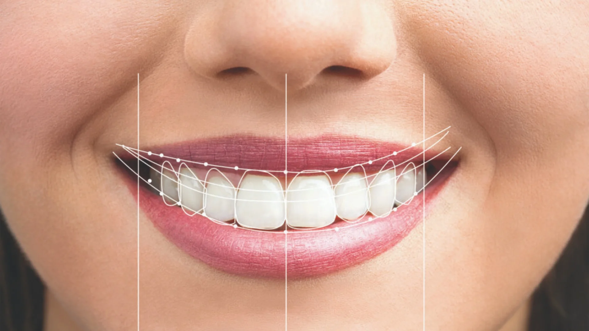 Hollywood Smile aesthetic result in Dubai
