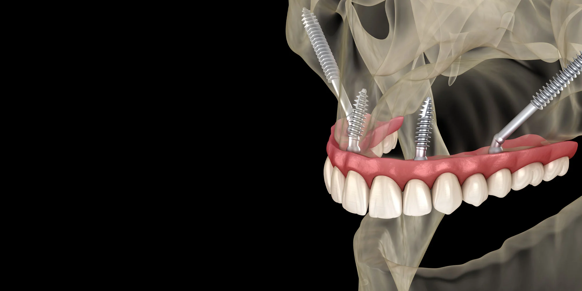 Clinical illustration showing zygomatic dental implant placement