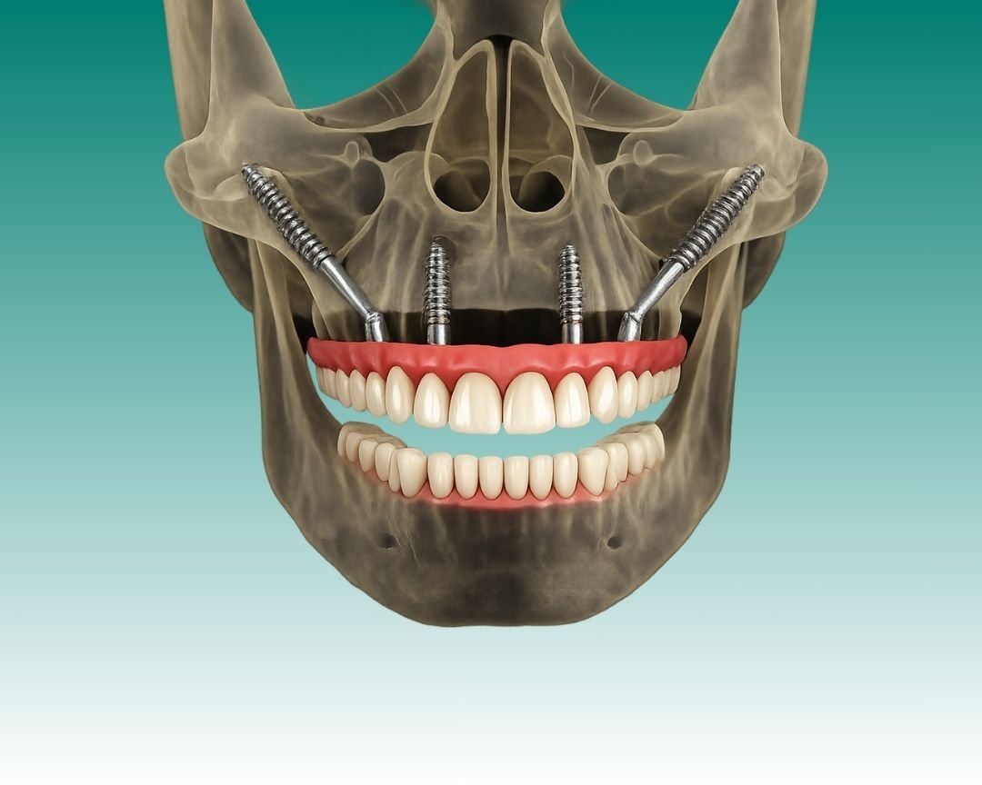 Zygomatic dental implant clinical illustration