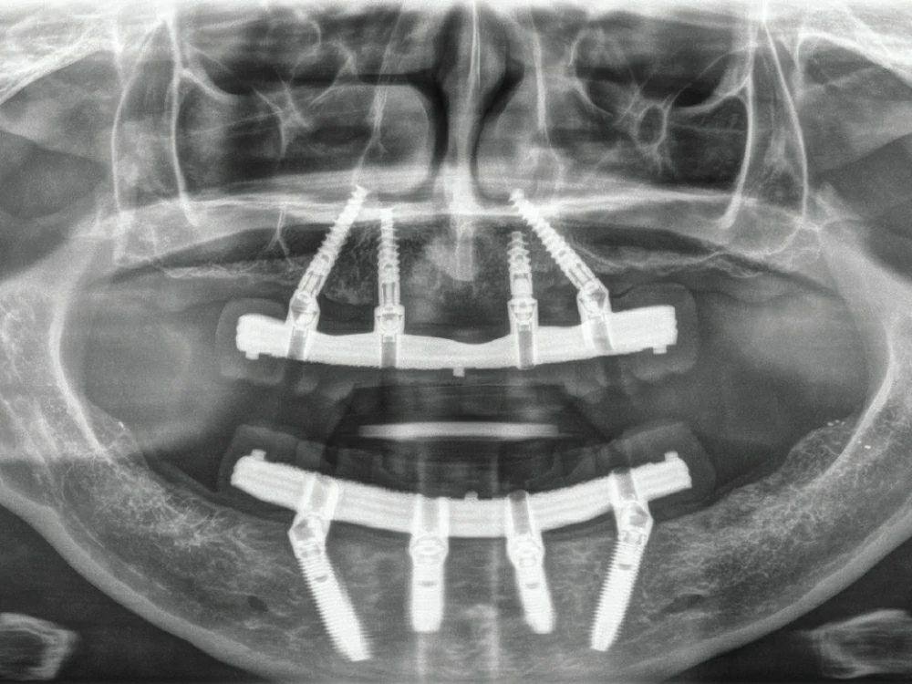 Clinical All-on-4 full-arch dental implant restoration