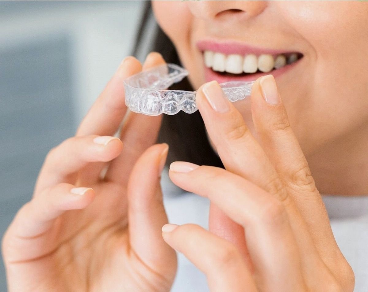 Clear aligners for orthodontic treatment — illustrative image