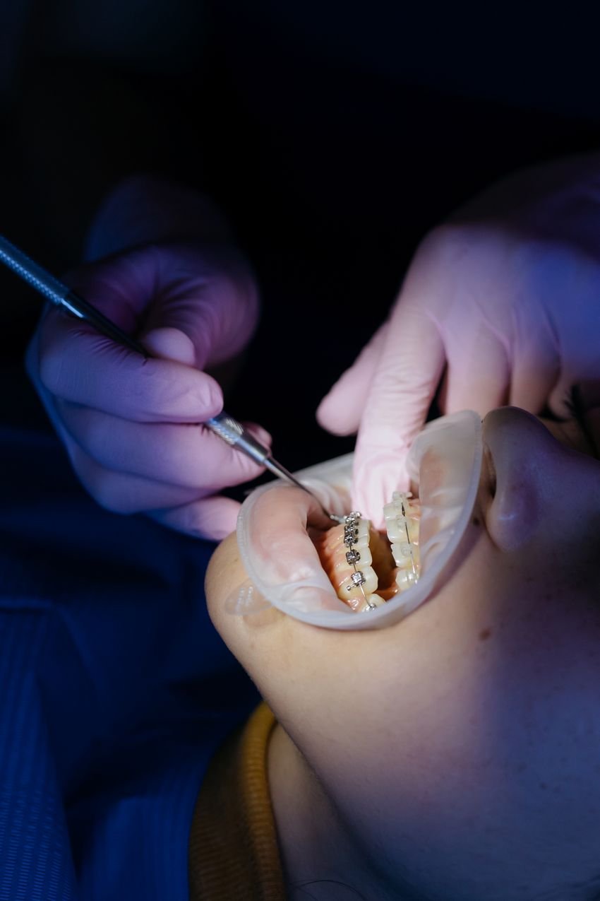 Retention Phase — illustrative orthodontic image